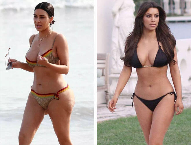 Фигура после липосакции без диет &ndash; 34 месяца