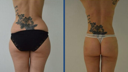 Фото до&nbsp;после липосакции: сохранить такой результат поможет спорт