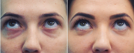 Фото до&nbsp;после жиросохраняющей блефаропластики