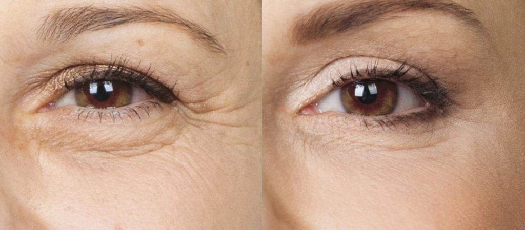 Жиросохраняющая блефаропластика фото до&nbsp;после