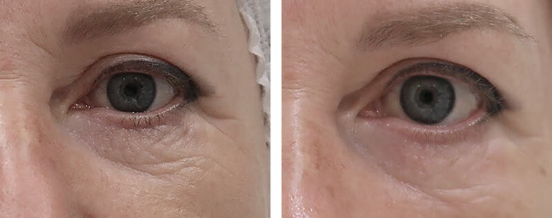 Жиросохраняющая блефаропластика фотографии до&nbsp;после