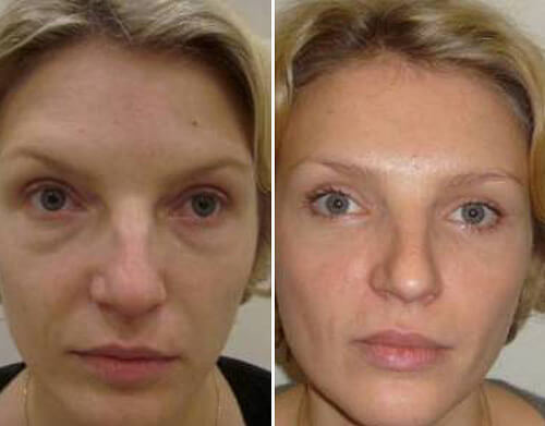 Фото до&nbsp;после блефаропластики