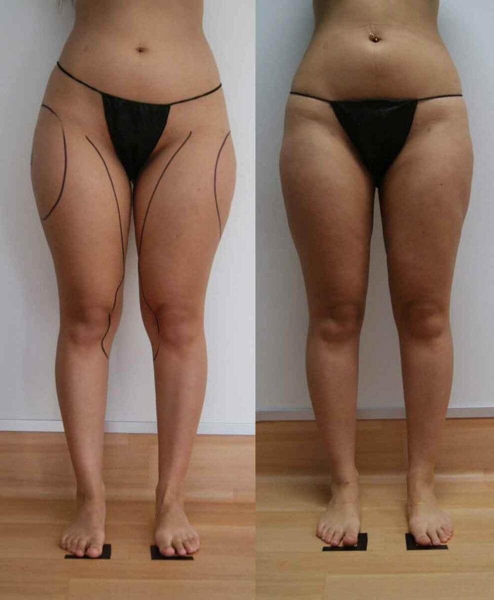 Лучших результатов позволяет добиться комплексная липосакция: колени, галифе, внутренняя поверхность бедер