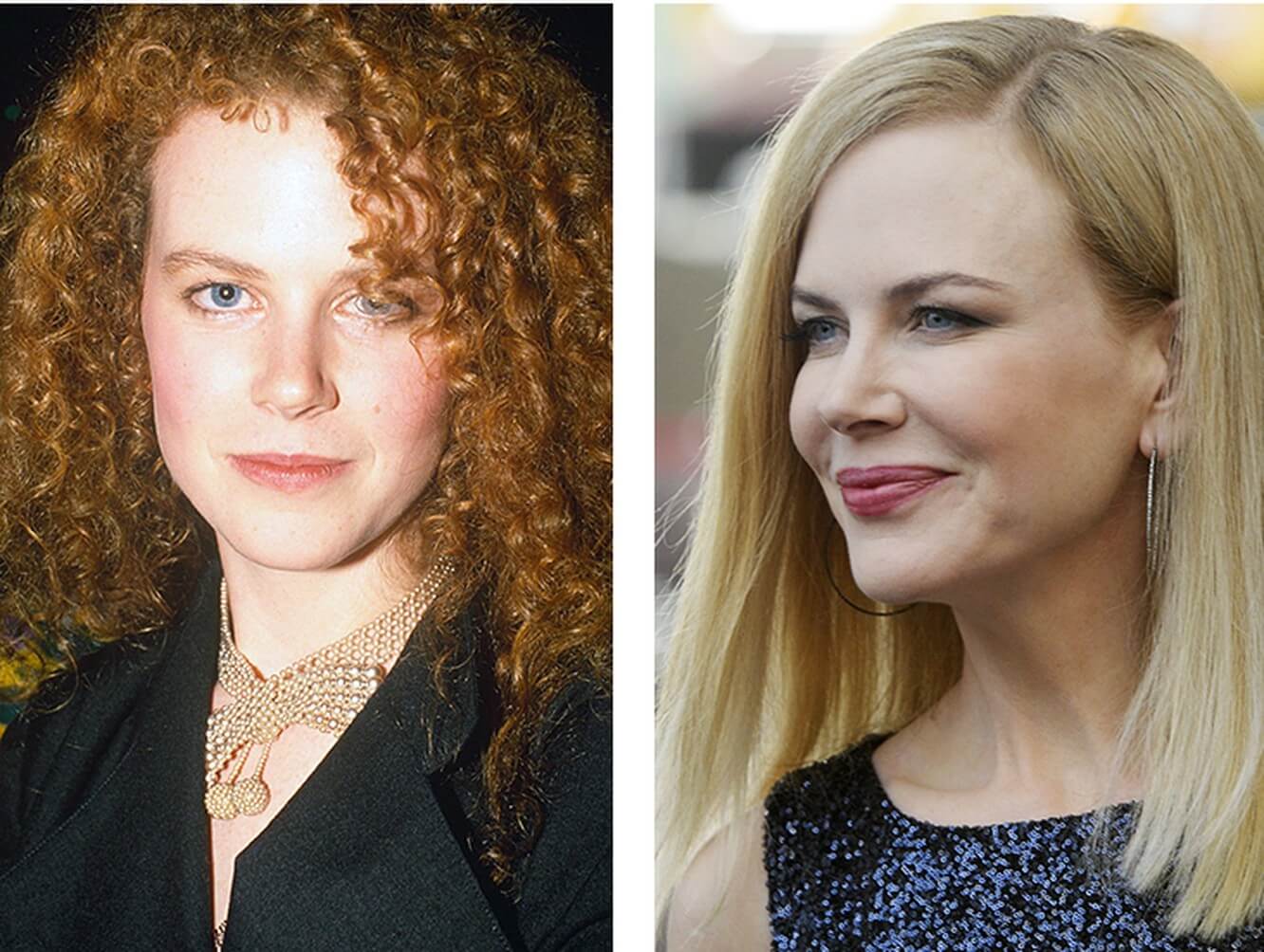 Николь Кидман – фото до и после пластики