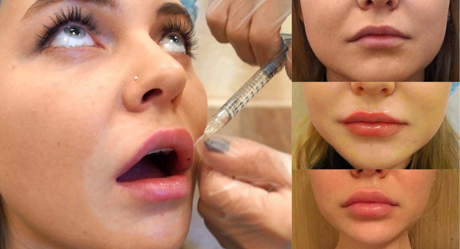 Увеличение губ филлерами на основе гиалуроновой кислоты