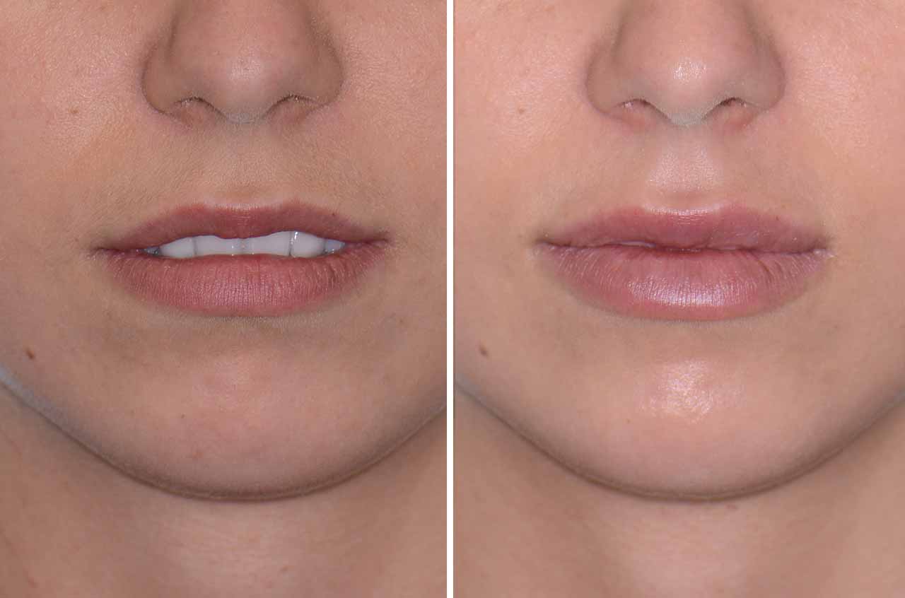 Хейлопластика: фото до и после операции