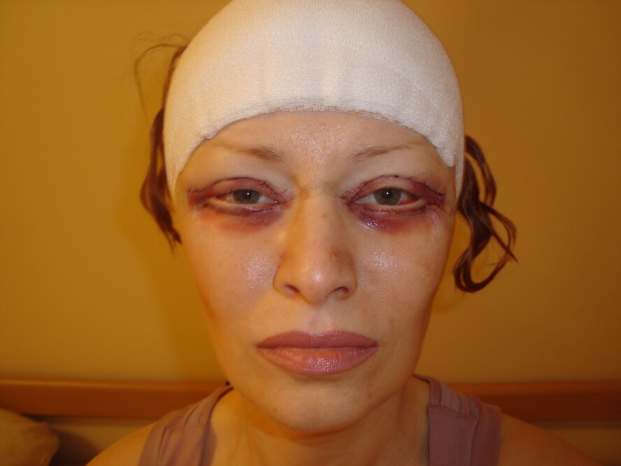 Блефаропластика – фото в 1 день