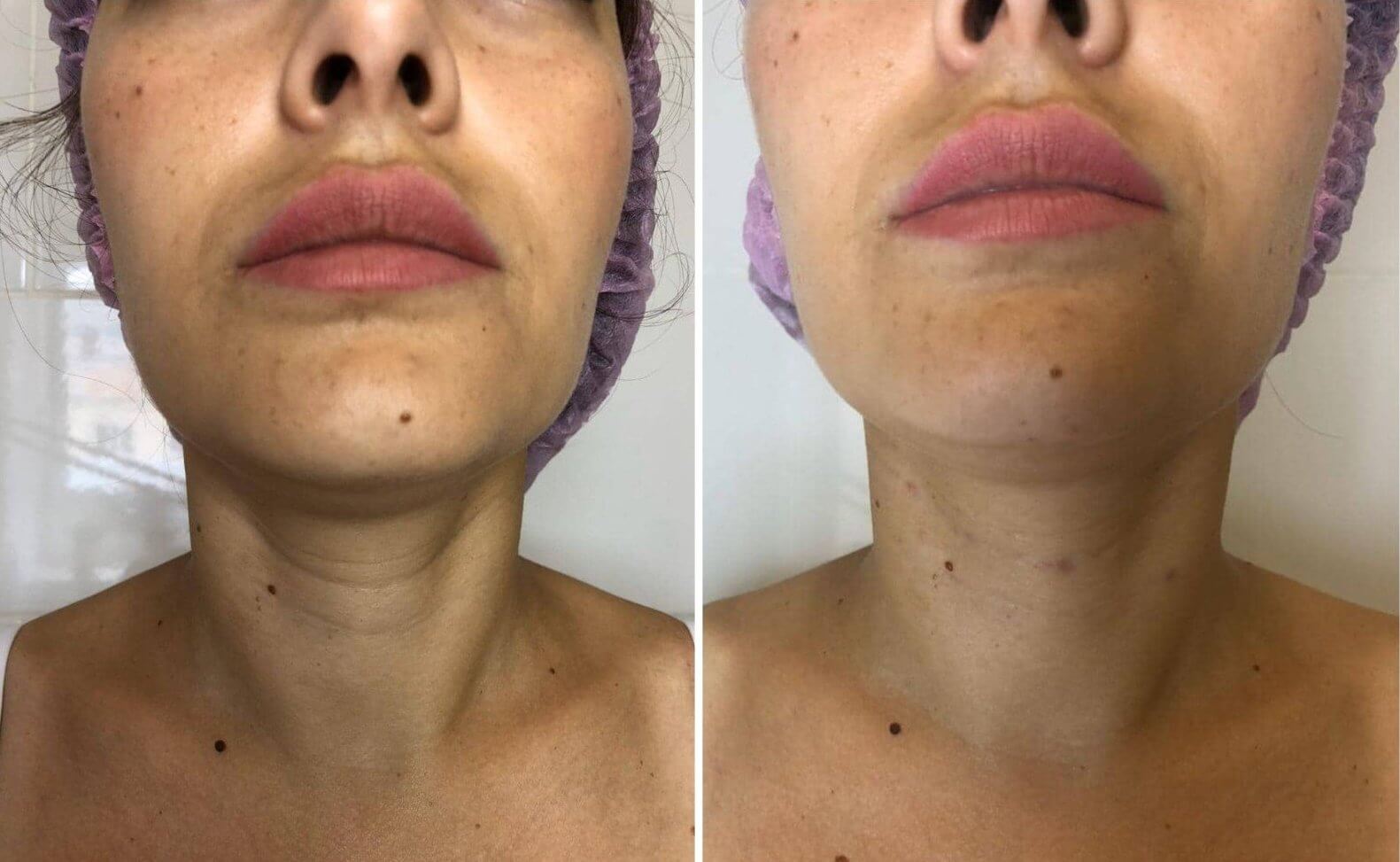 Платизмопластика – фото до и после операции