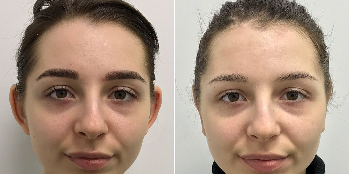 Отопластика &ndash; одна из&nbsp;самых популярных операций в&nbsp;20 лет