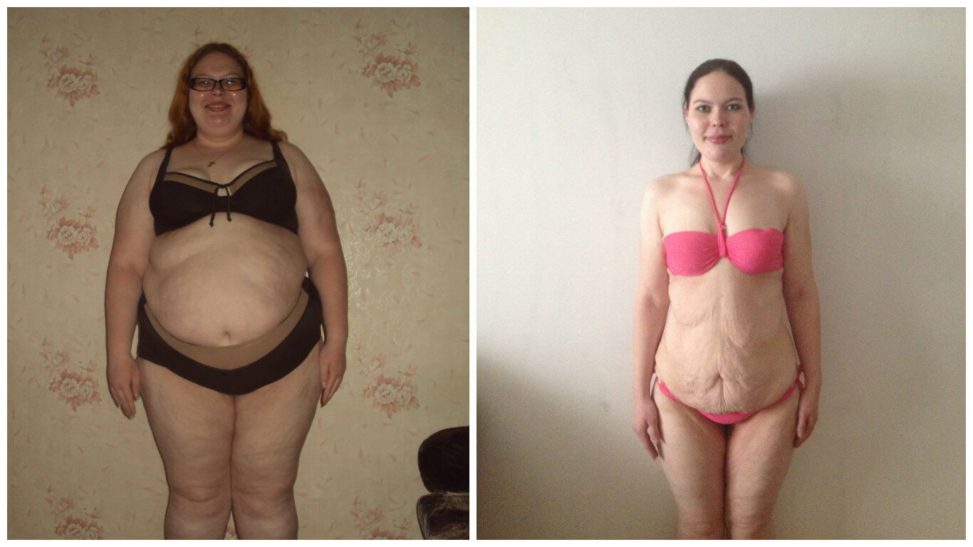 После похудения на&nbsp;много кг даже в&nbsp;юные годы кожа на&nbsp;животе сильно обвисает 