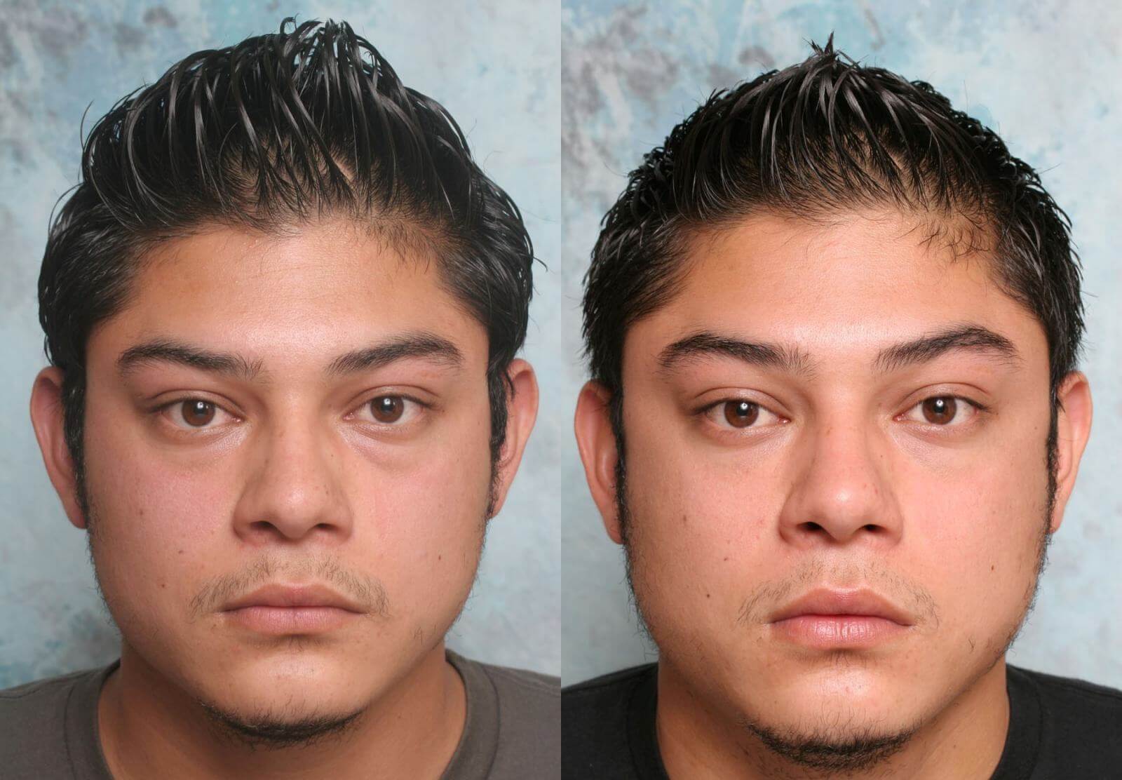 Мешки под&nbsp;глазами могут беспокоить и&nbsp;в&nbsp;20 лет, и&nbsp;даже раньше