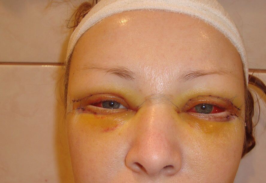 Блефаропластика – фото во 2 день. Отеки и краснота нарастают