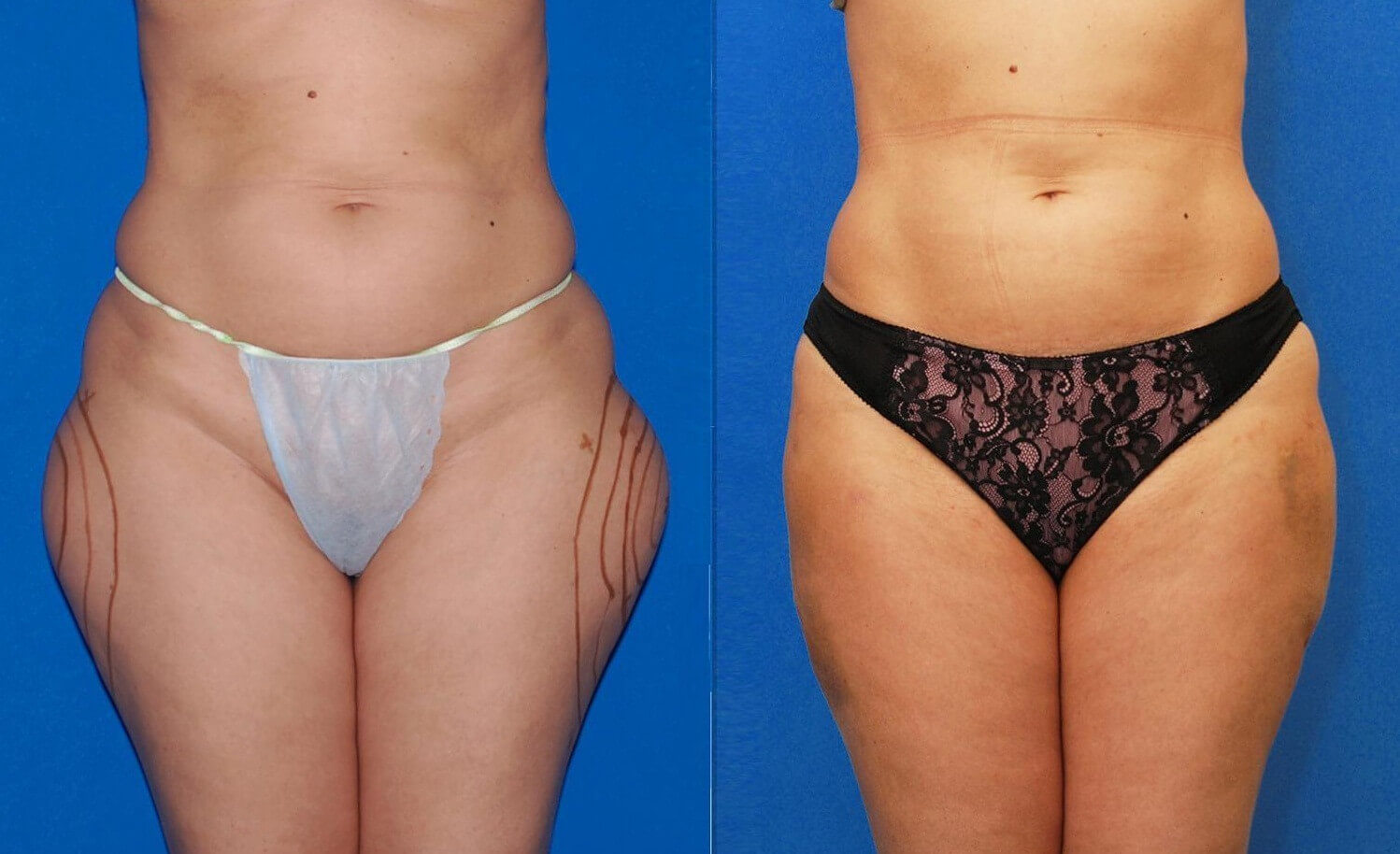 Контурная пластика позволяет избавиться от проблем, которые не устранить диетами и спортом