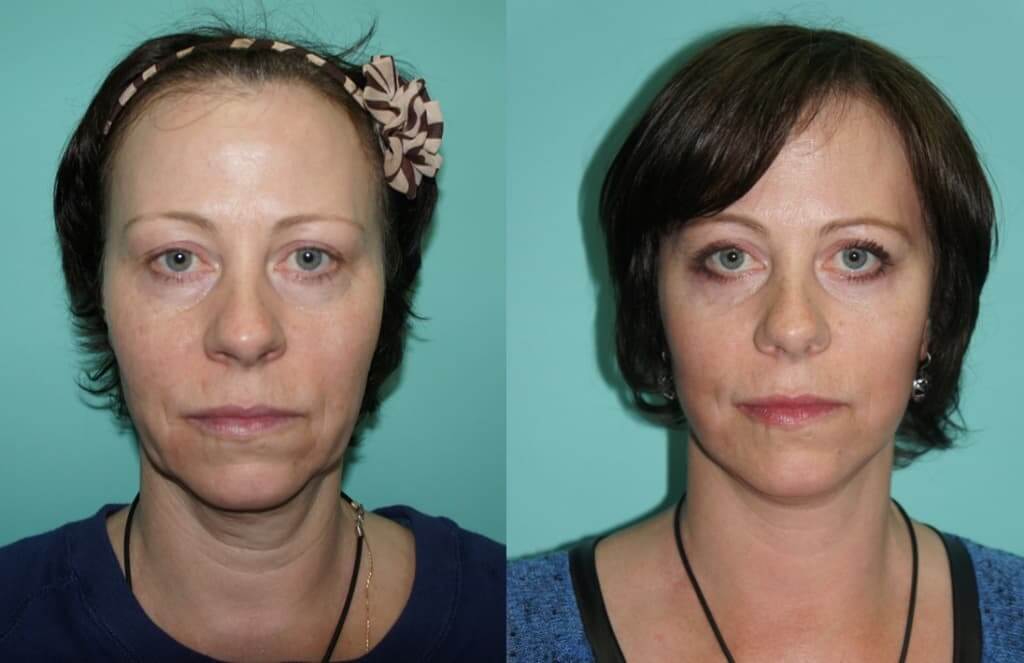 Лучшего эффекта позволяет добиться комплексная подтяжка лица и шеи. Фото до и после