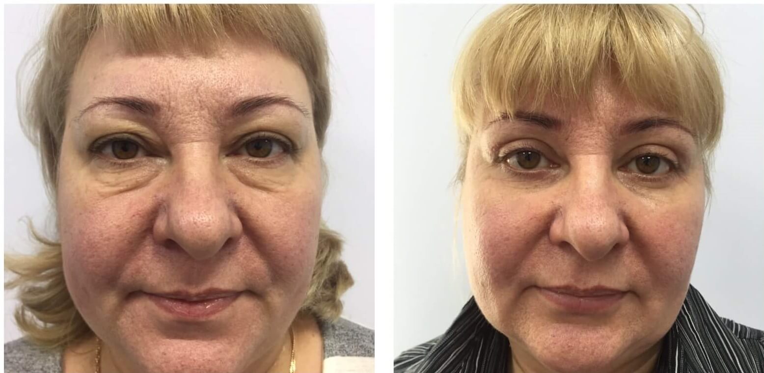 Грамотно проведенная блефаропластика дает отличный результат с первого раза