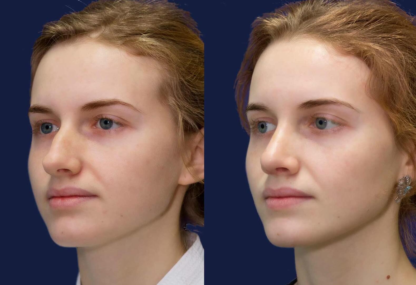 Ринопластика – очень сложная операция, которую лучше не делать дважды