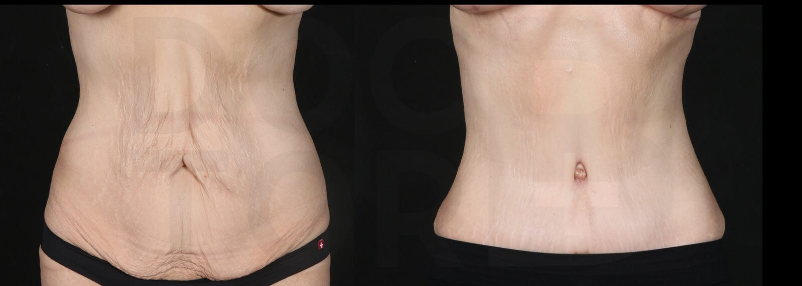 Абдоминопластика позволяет избавиться не только от диастаза, но и от обвисшей кожи и растяжек.