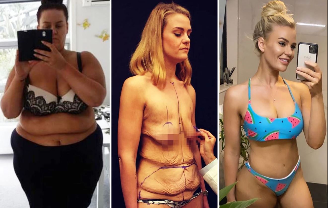 Сначала похудение, затем – пластика. Идеальный путь к фигуре мечты