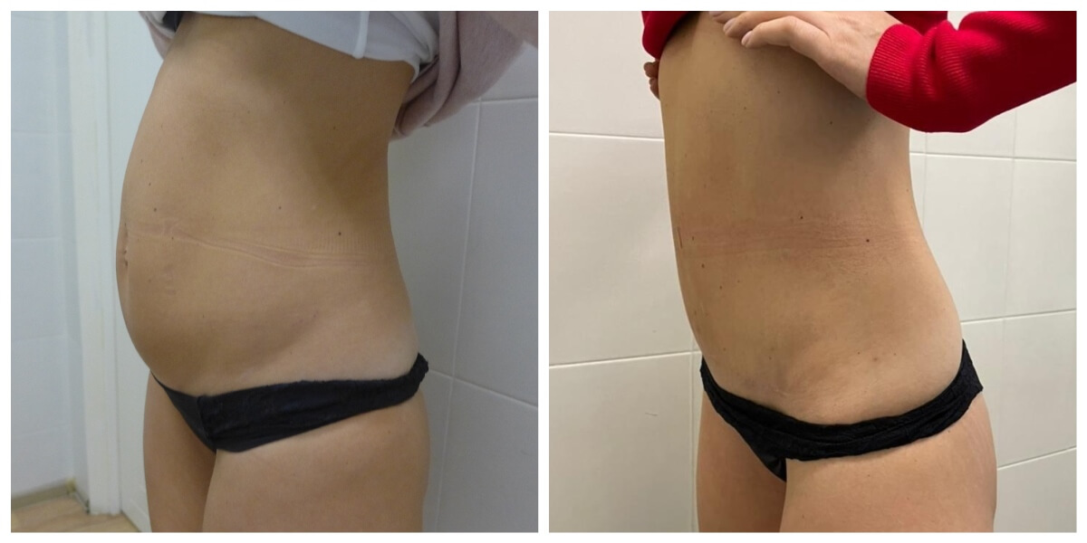 Абдоминопластика с ушиванием диастаза: фото до и после