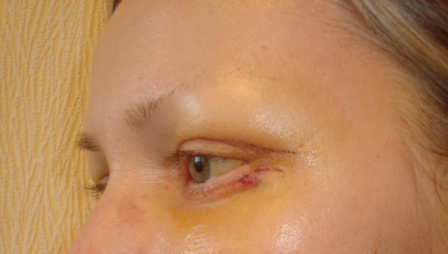 Блефаропластика – фото через 1-2 недели. Отеки и синяки постепенно сходят