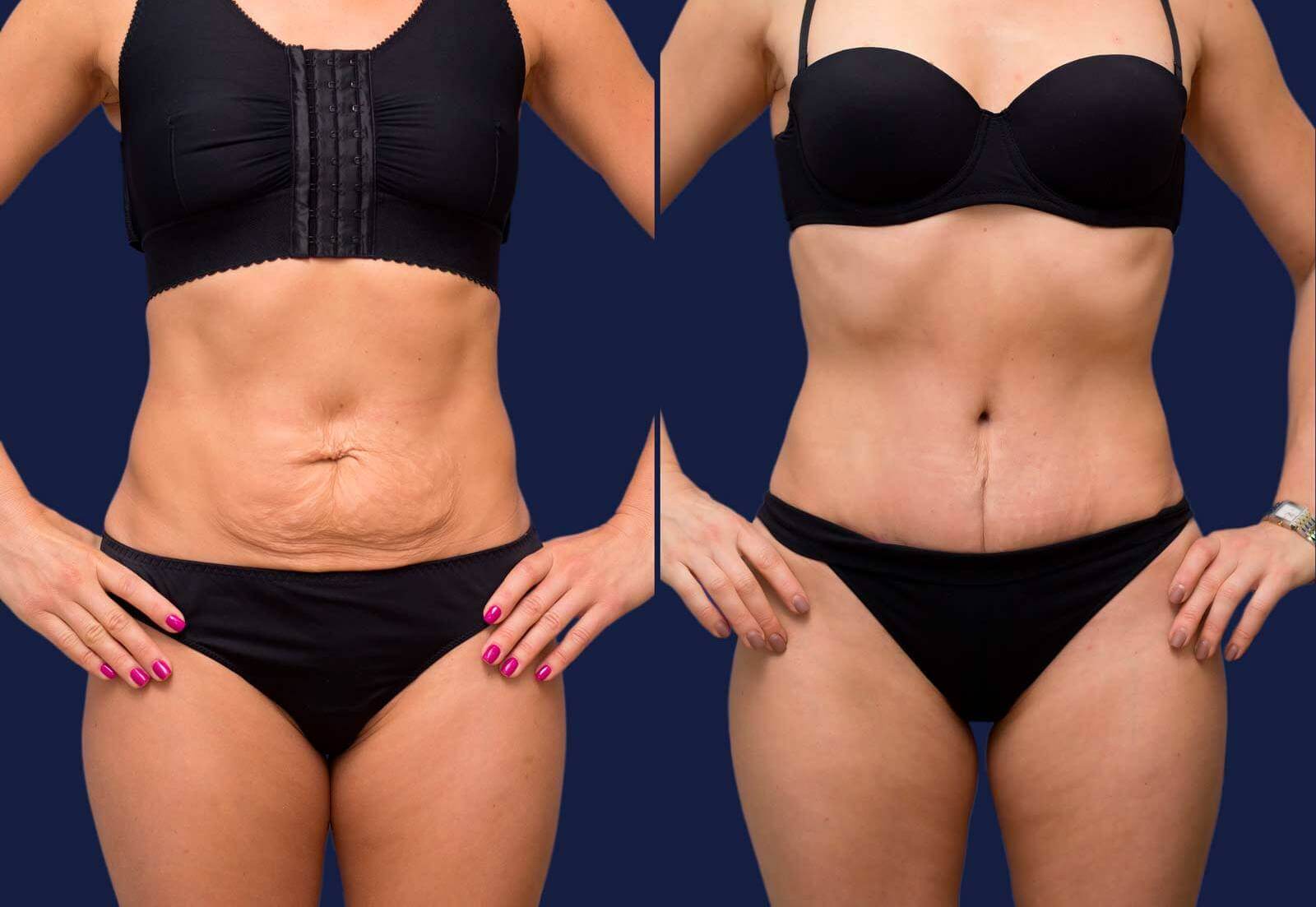 Контурная пластика доводит фигуру до совершенства