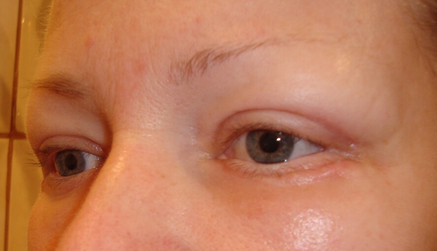 Блефаропластика – фото через 1 месяц. Швы еще заметны и есть небольшой отек, но результаты уже налицо