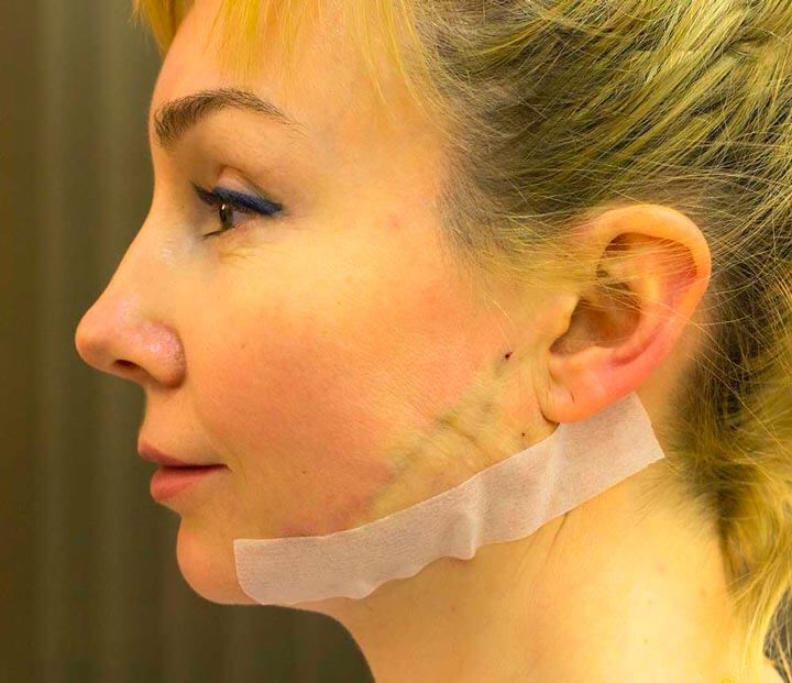 Шрамы после любой пластики располагаются так, чтобы их было незаметно