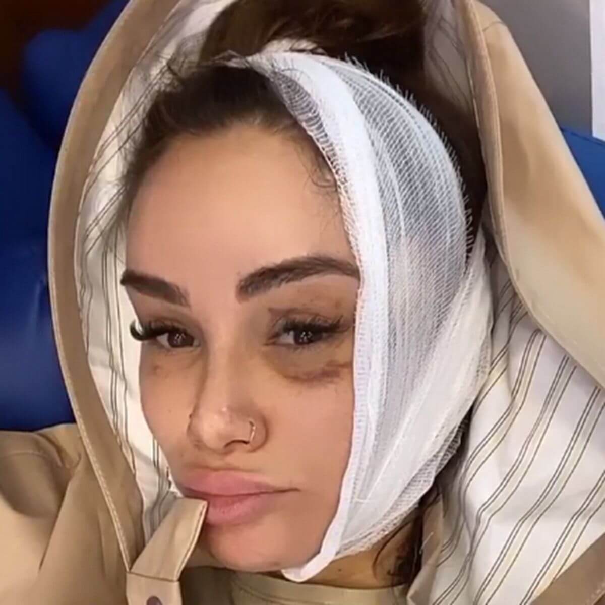 Айза активно делится процессом восстановления после трансплантации волос с подписчиками