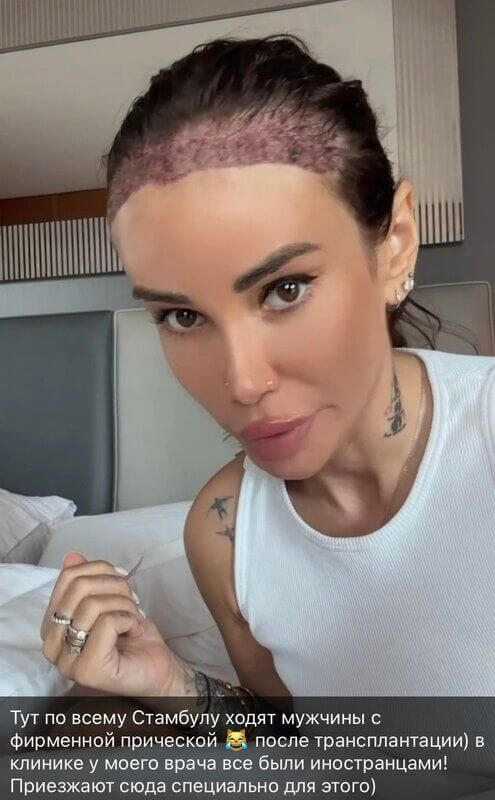 … но совсем скоро в зоне пересадки вырастут полноценные волосы