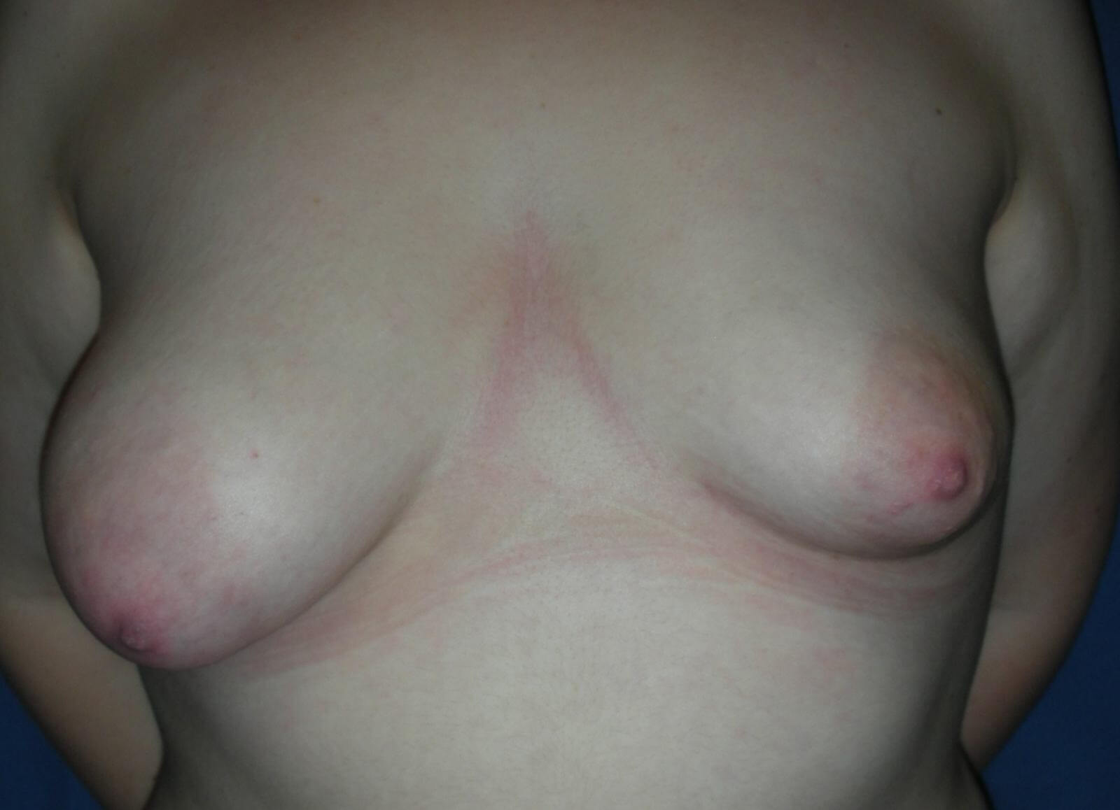 Асимметрия груди – распространенное явление после рождения и кормления ребенка