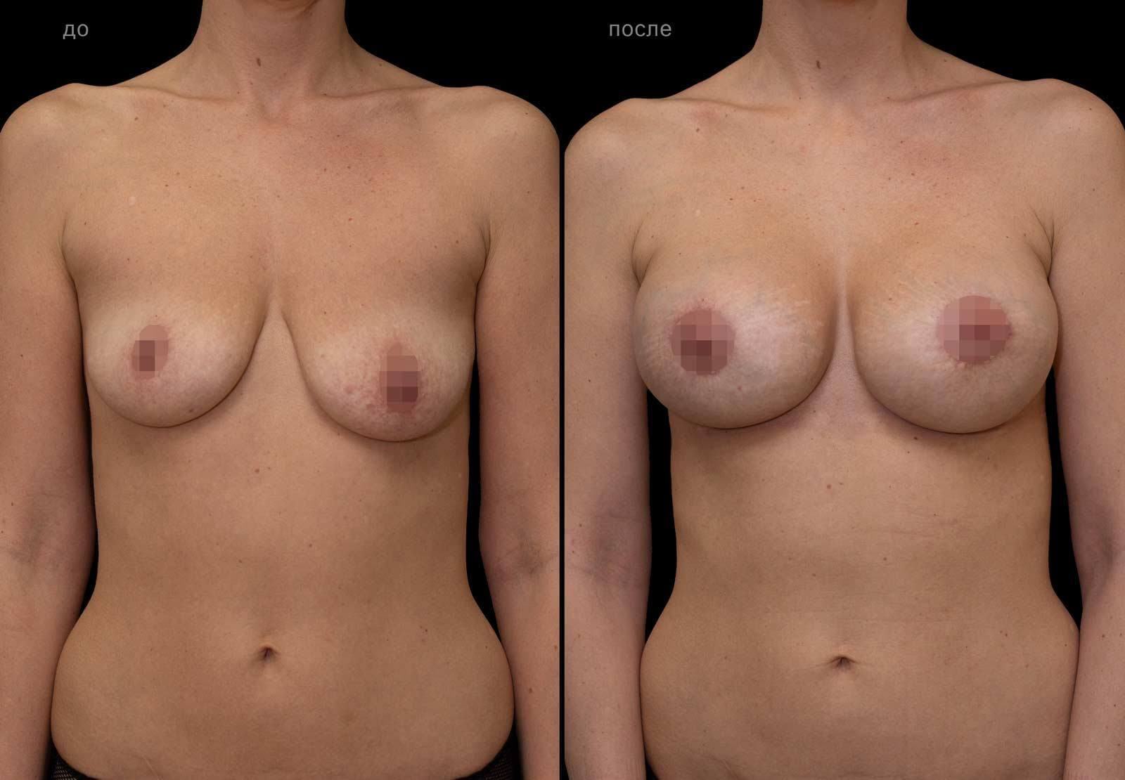 Коррекция асимметрии груди – фото до и после