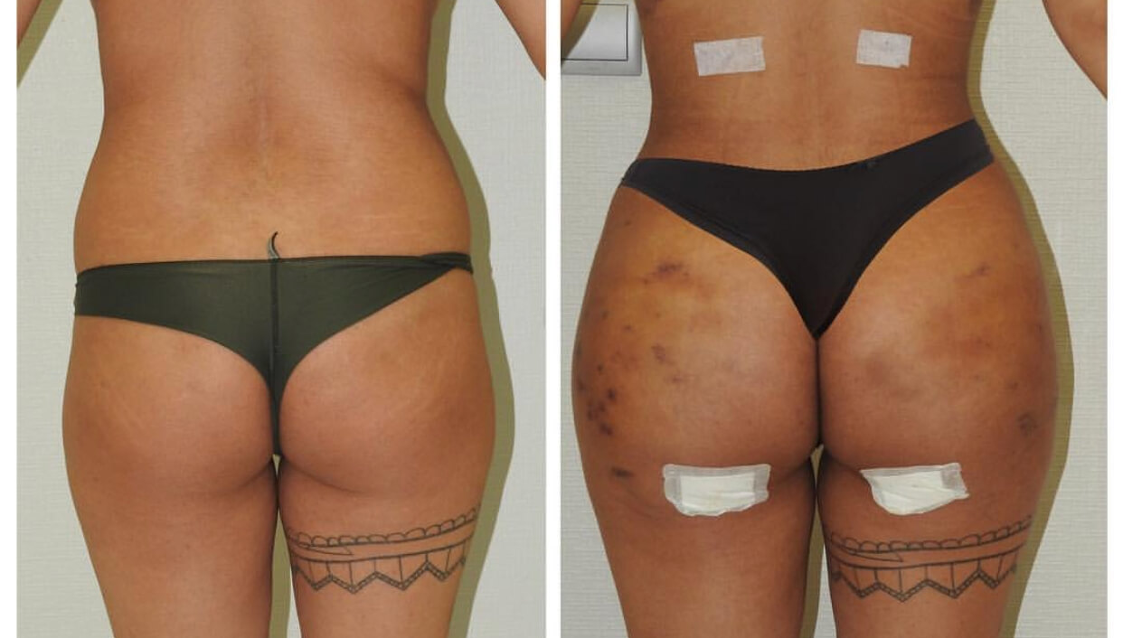 Липофилинг корректирует асимметрию и недостаток объема ягодиц без лишних шрамов