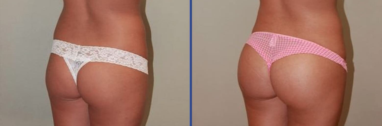 Импланты мгновенно преображают внешний вид ягодиц. Никакой асимметрии и привлекательный объем