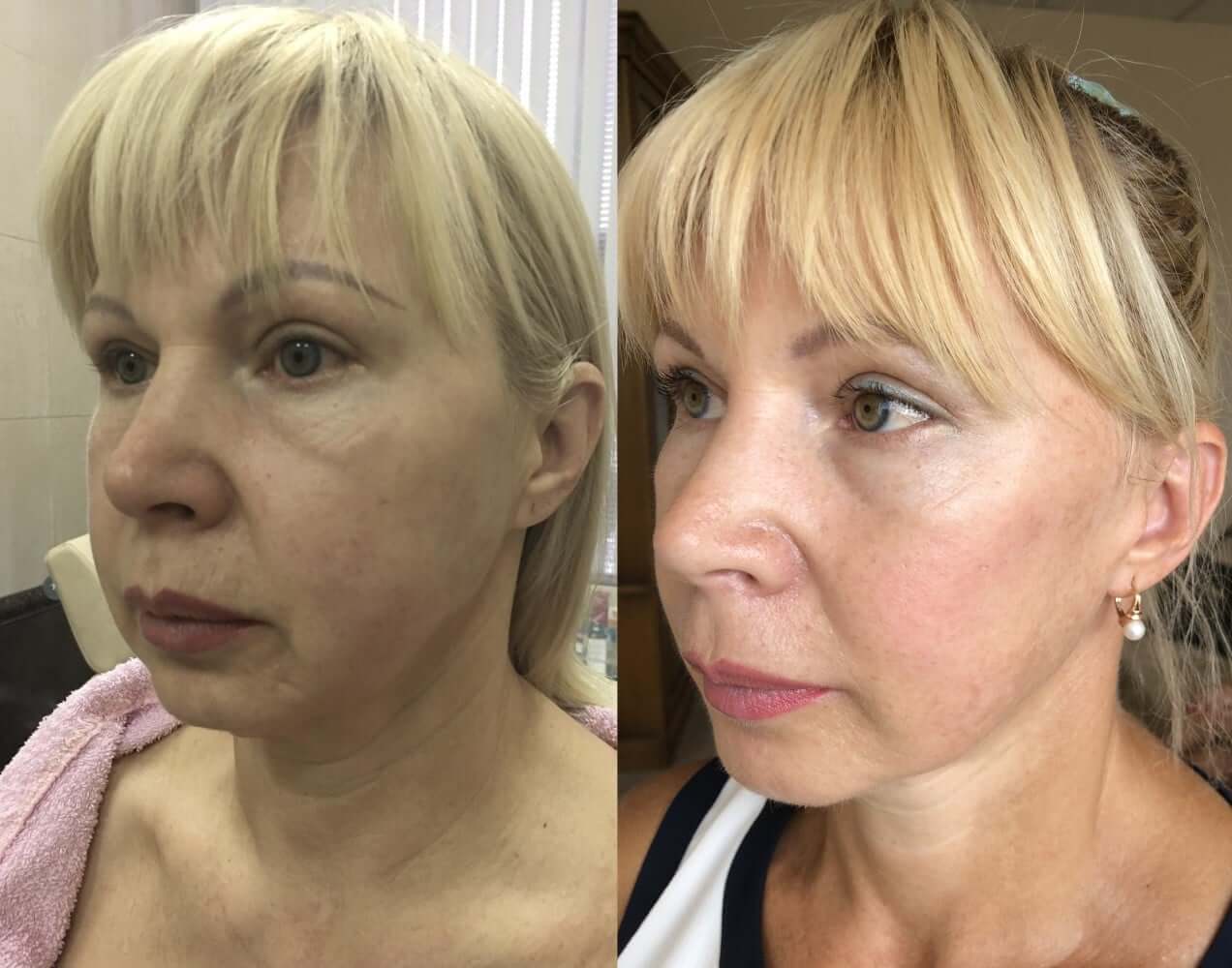SMAS-лифтинг &ndash; лицо до&nbsp;и&nbsp;после операции