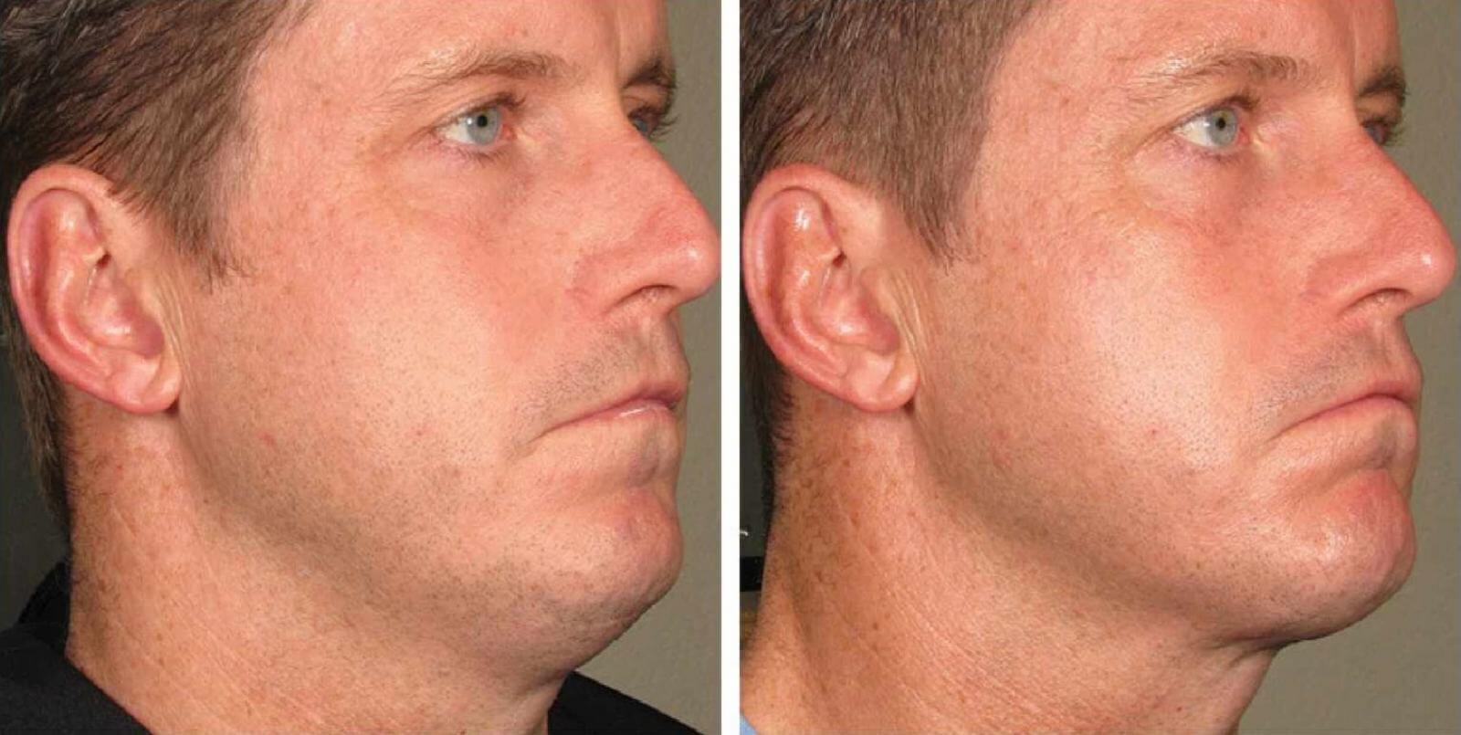 Результаты фейслифтинга у&nbsp;мужчины