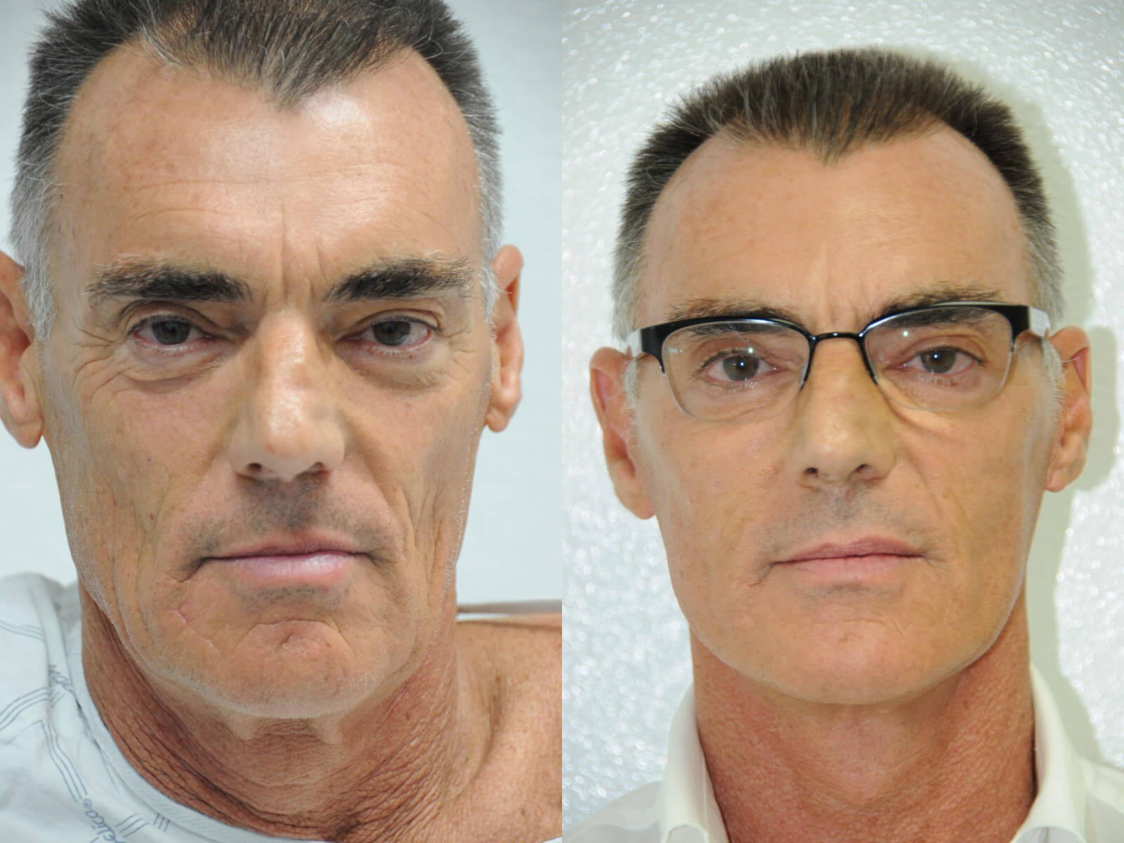 Мужская подтяжка лица &ndash; до&nbsp;и&nbsp;после