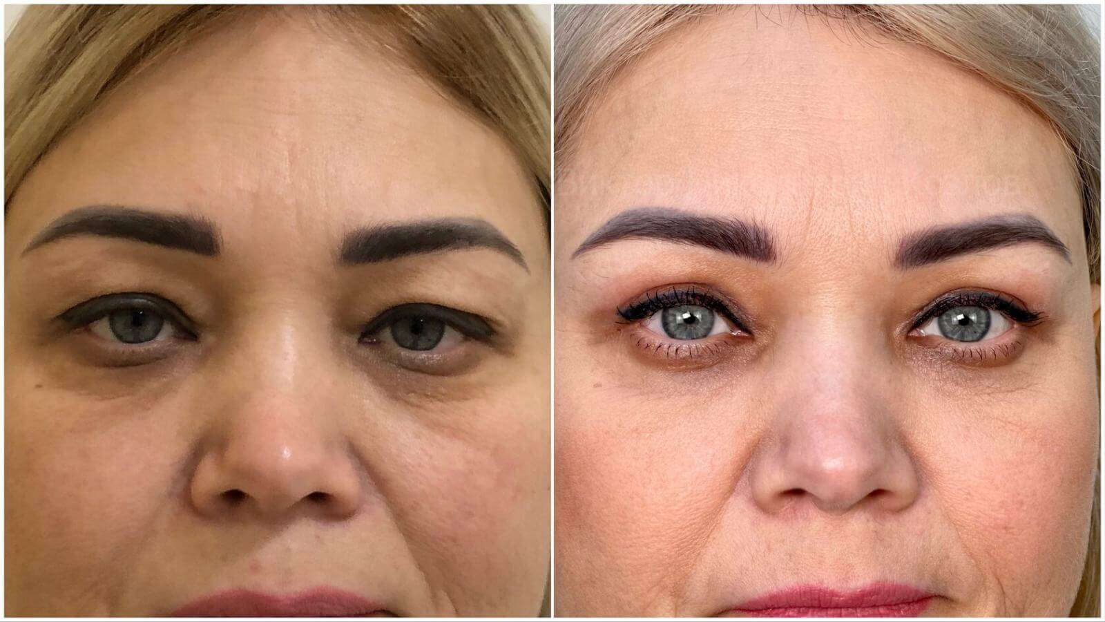 Блефаропластика &ndash; до&nbsp;и&nbsp;после