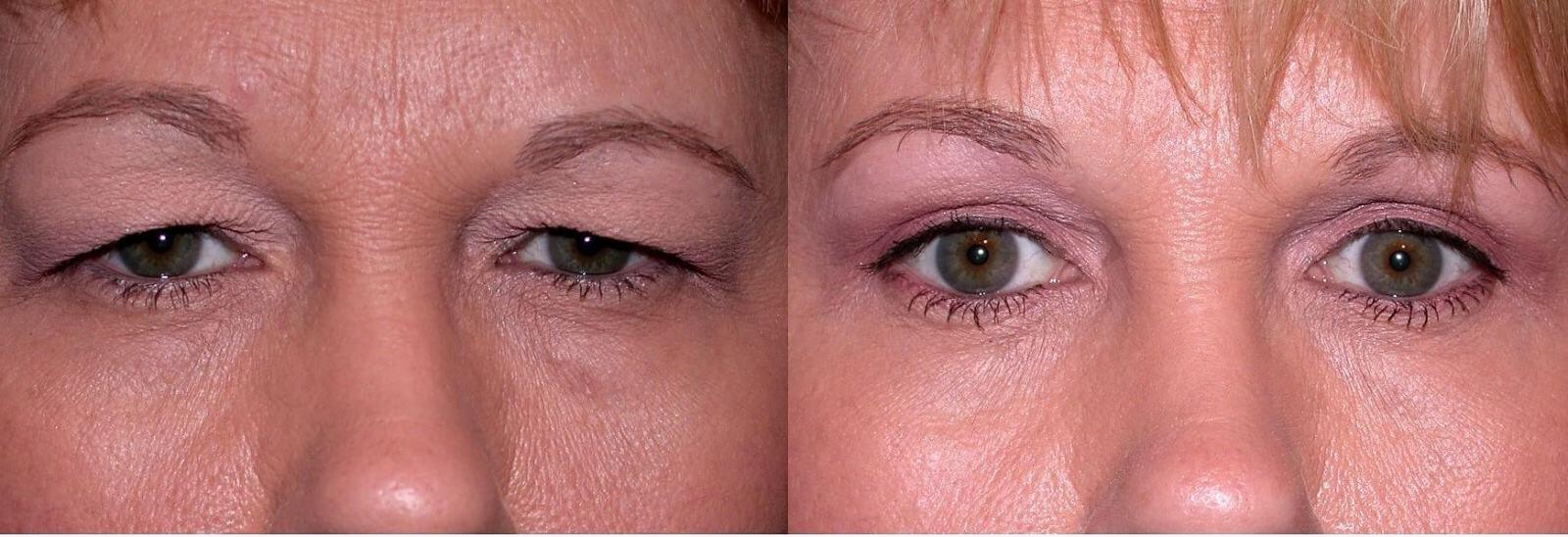 Блефаропластика борется с&nbsp;серьезными признаками старения: нависшими веками, опустившимися кончиками глаз, мешками