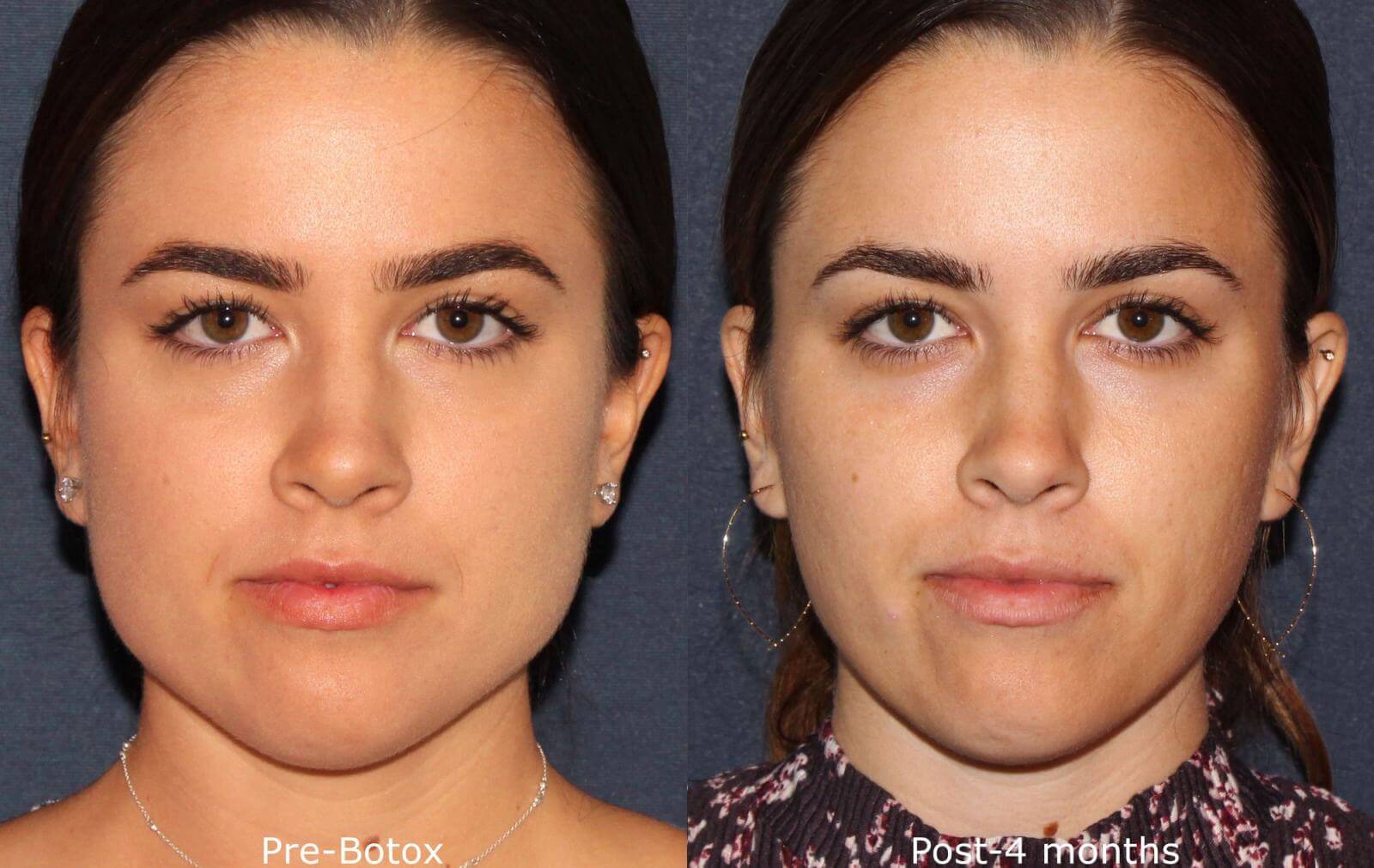 Результат инъекций ботокса в&nbsp;жевательные мышцы выглядит вдохновляюще