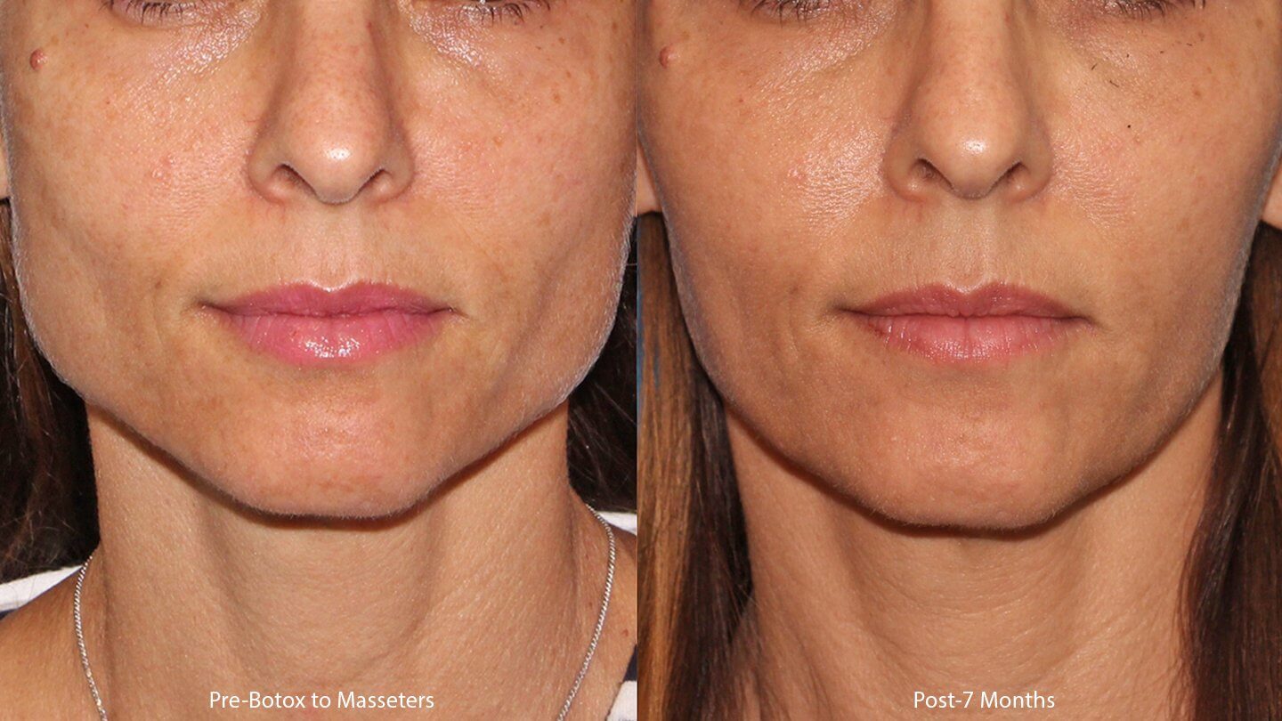 Через 5-7 месяцев инъекции ботокса повторяют