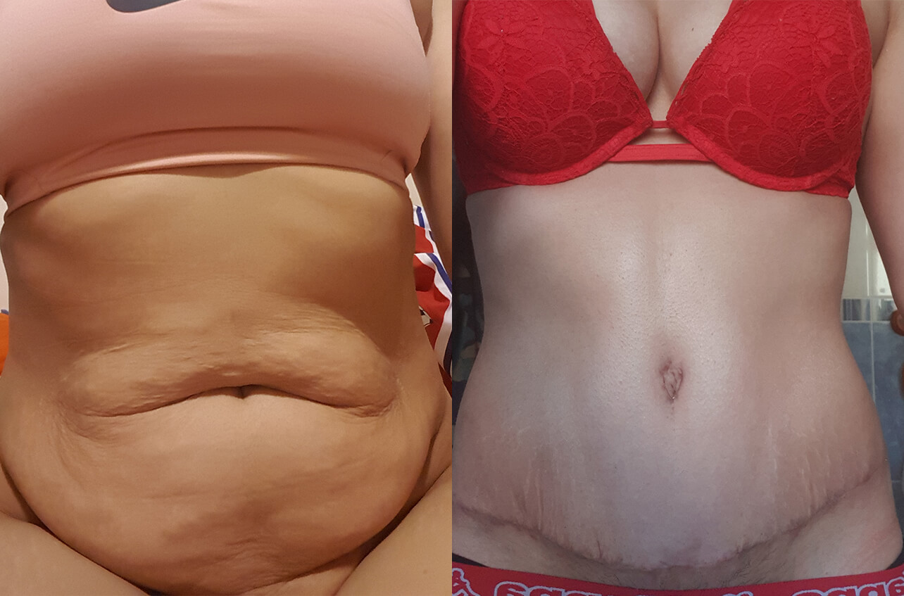 Абдоминопластика убирает с живота лишний жир, а за кубиками надо идти в спортзал