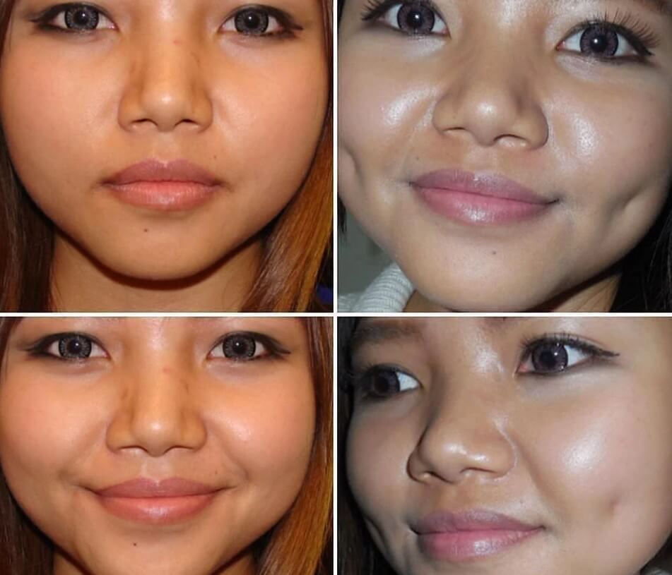 Димплэктомия – фото до и после процедуры для наглядного сравнения