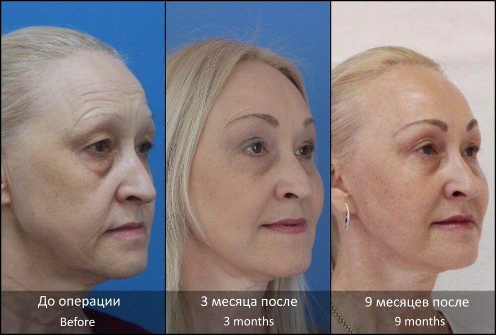 Лучший вариант фото до&nbsp;и&nbsp;после &ndash; серия снимков с&nbsp;разницей в&nbsp;несколько месяцев