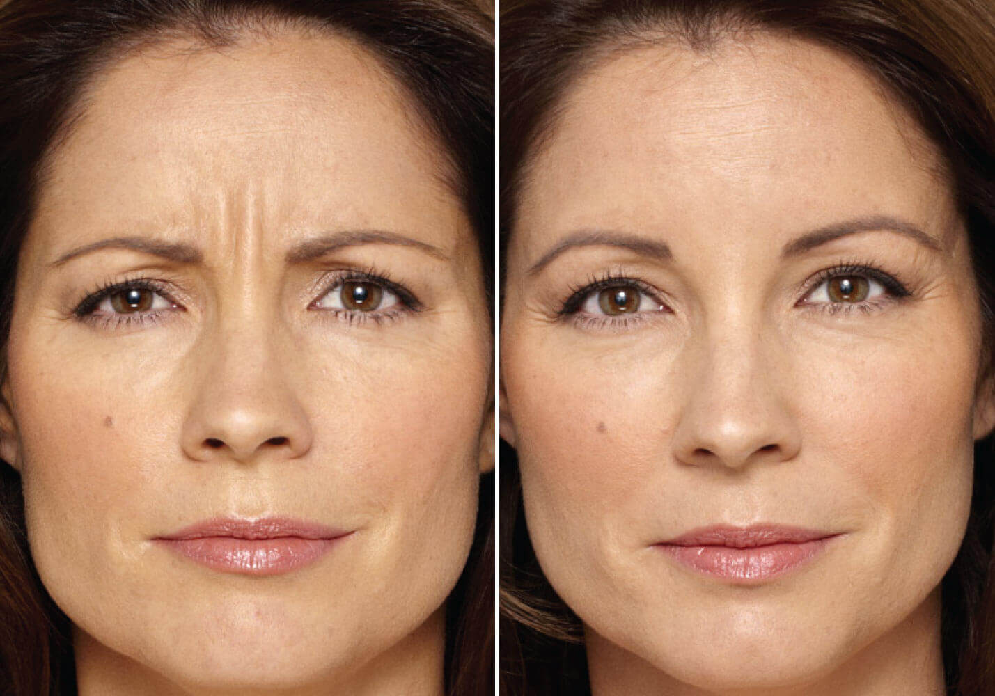 Удачный ботокс всегда выглядит естественно