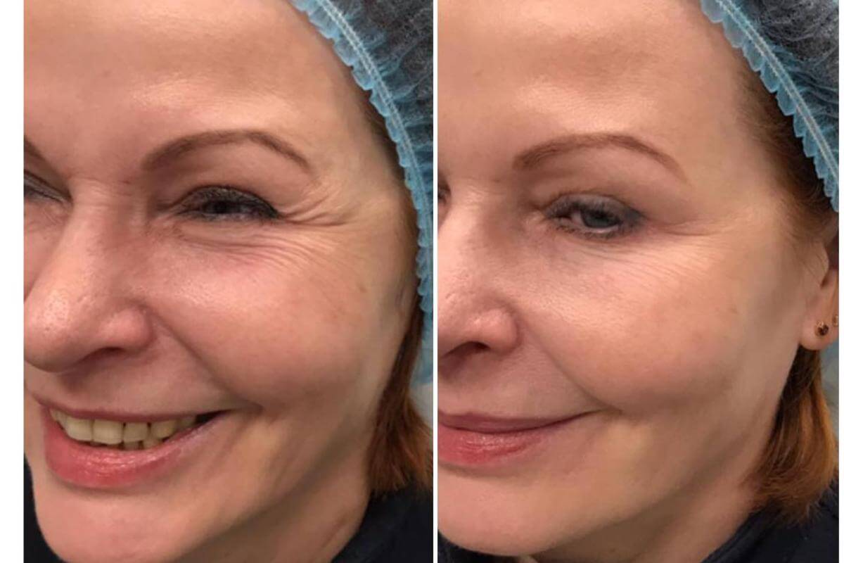 Ботокс: результаты до&nbsp;и&nbsp;после