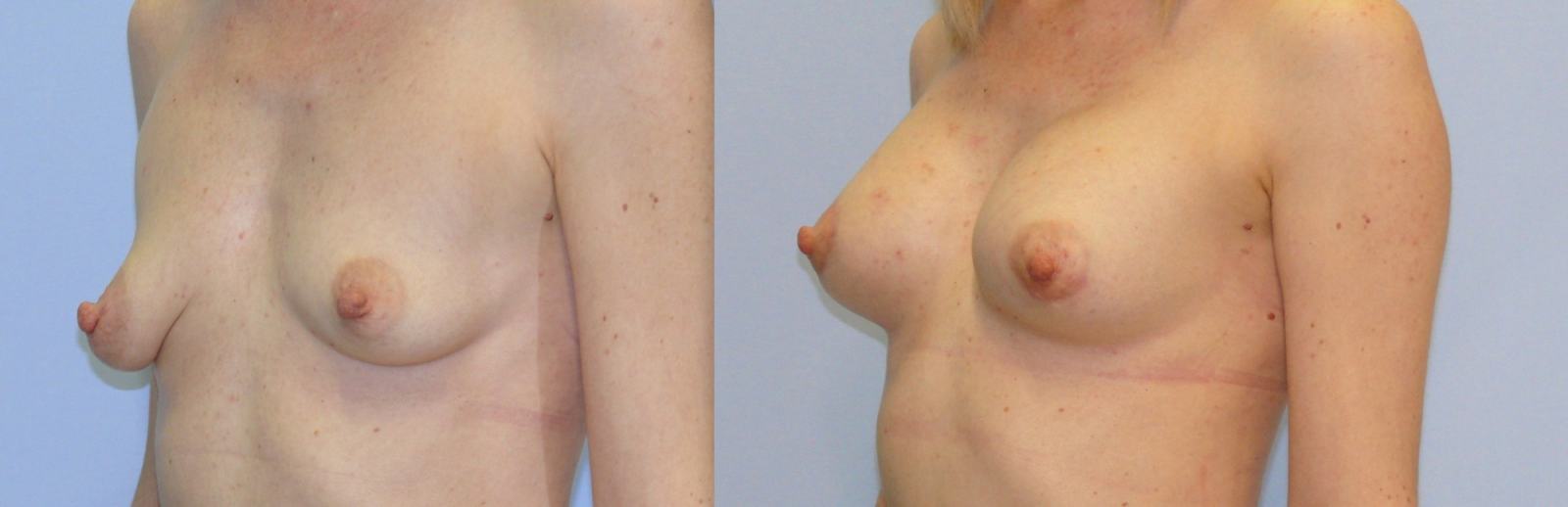 Мастопексия дает отличный результат, но&nbsp;не&nbsp;гарантирует его сохранение на&nbsp;всю жизнь