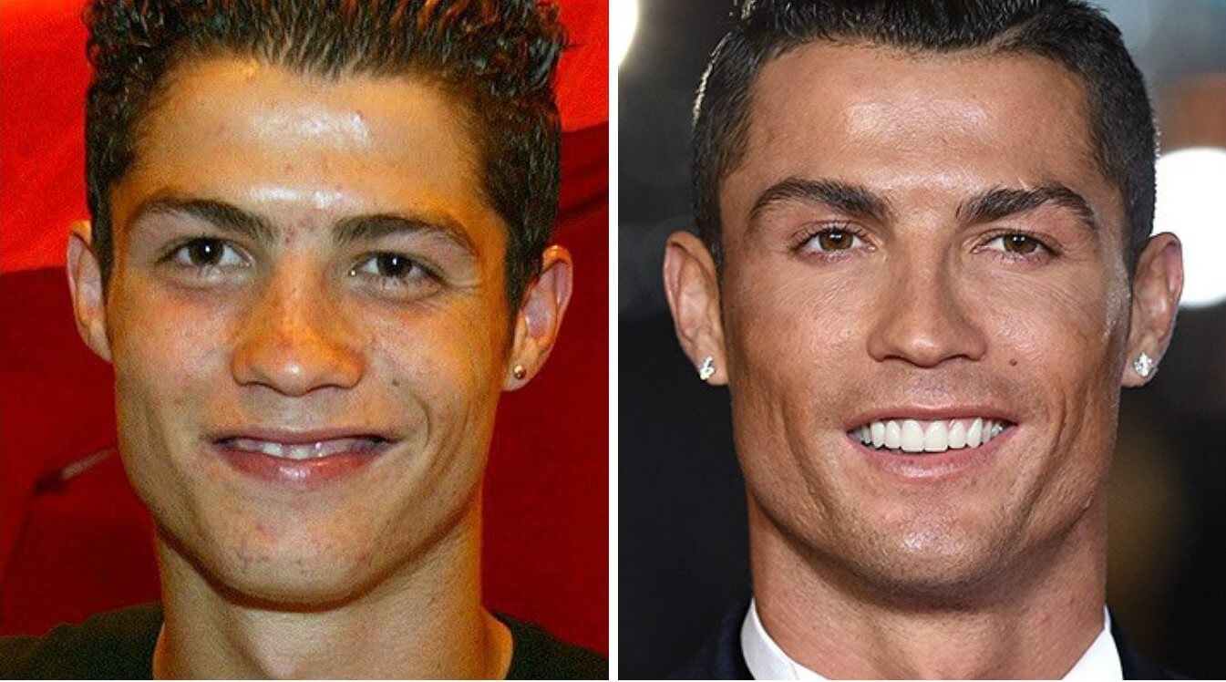 В нынешних фото Криштиану Роналду невооруженным взглядом видна работа хирургов и&nbsp;косметологов