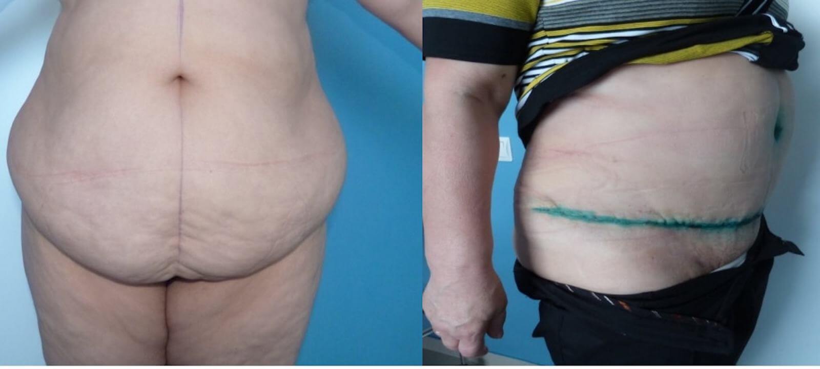 Даже самый большой и&nbsp;некрасивый живот можно привести в&nbsp;форму с&nbsp;помощью абдоминопластики