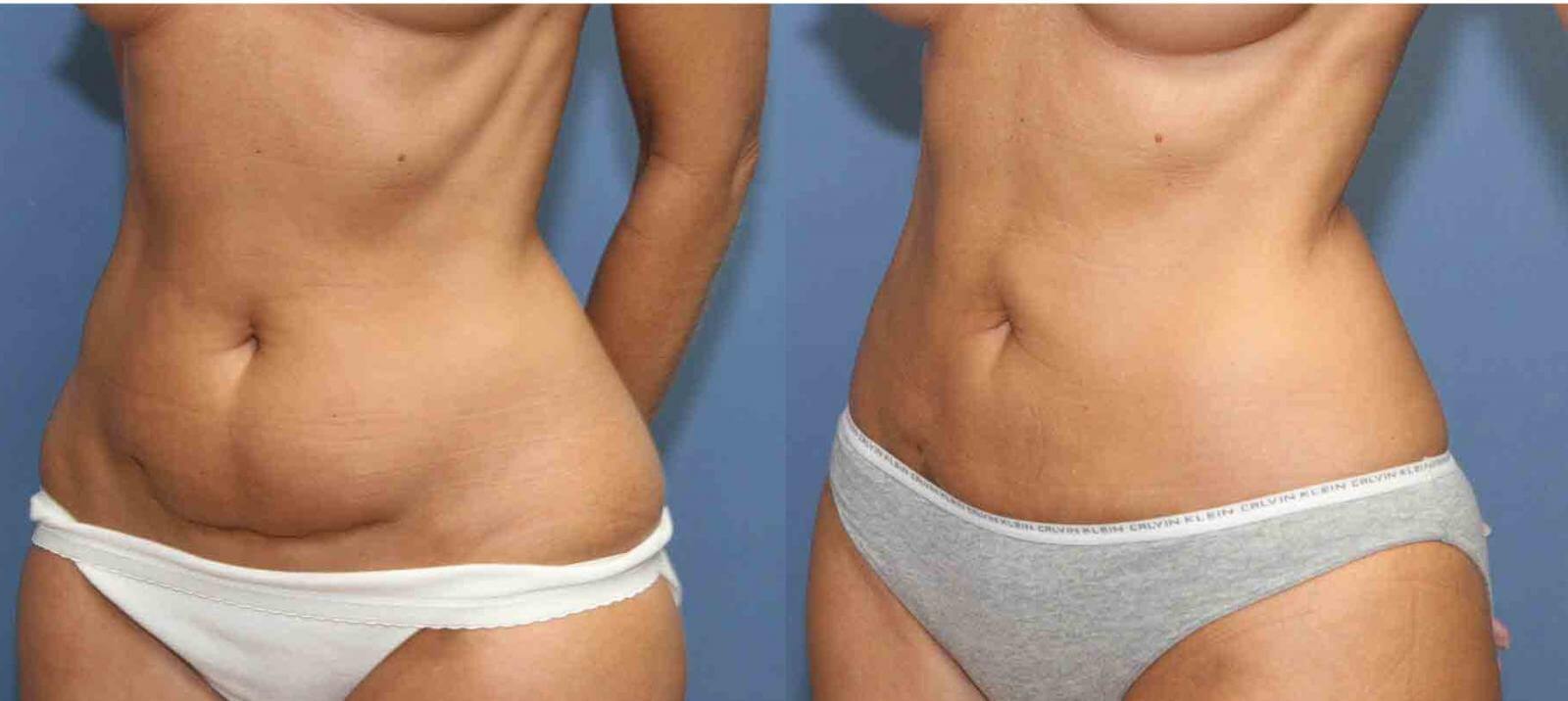 Правильная подготовка к&nbsp;пластике живота &ndash; залог отличного результата