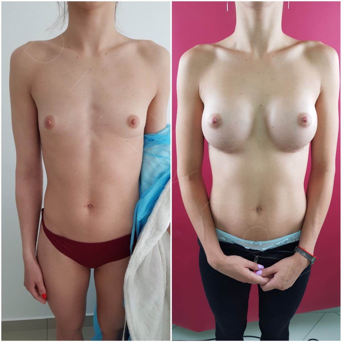 Увеличение груди 0 размера – фото до и после